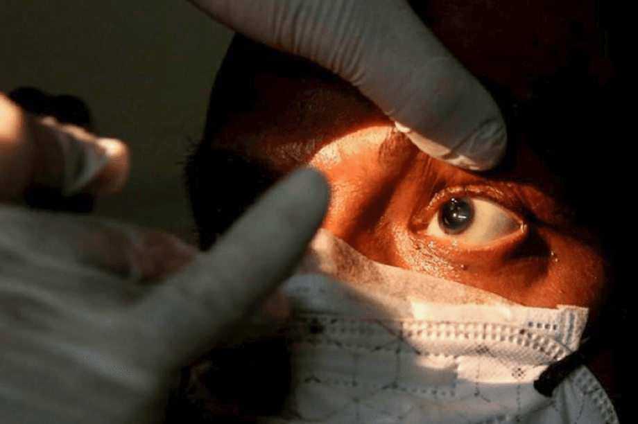 Detectan un caso de Hongo Negro en Tamaulipas; la mujer infectada perdió el ojo