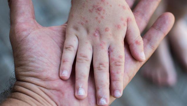 Secretaría de Salud alerta por brotes de sarampión y rubéola